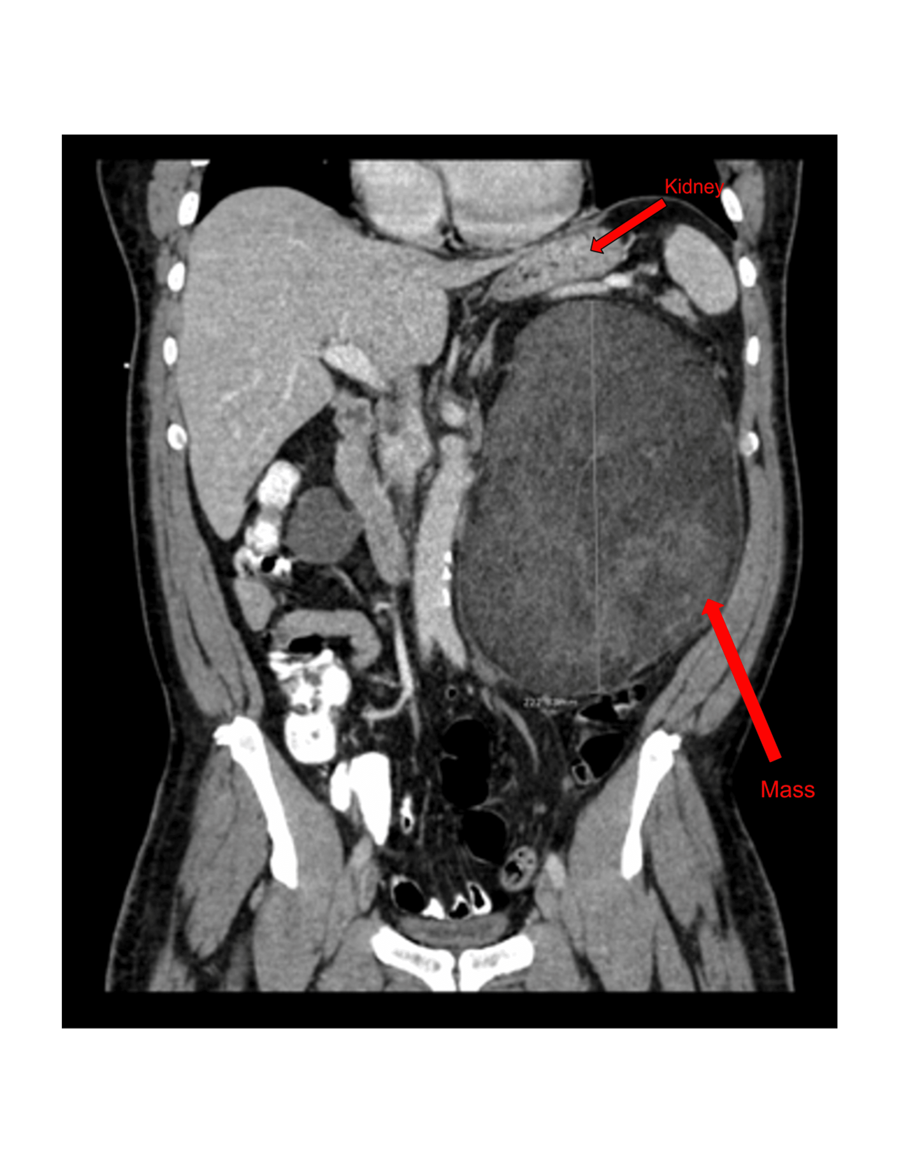 A Large Retroperitoneal Liposarcoma Mimicking An Angiomyolipoma On Pre Operative Imaging A Case