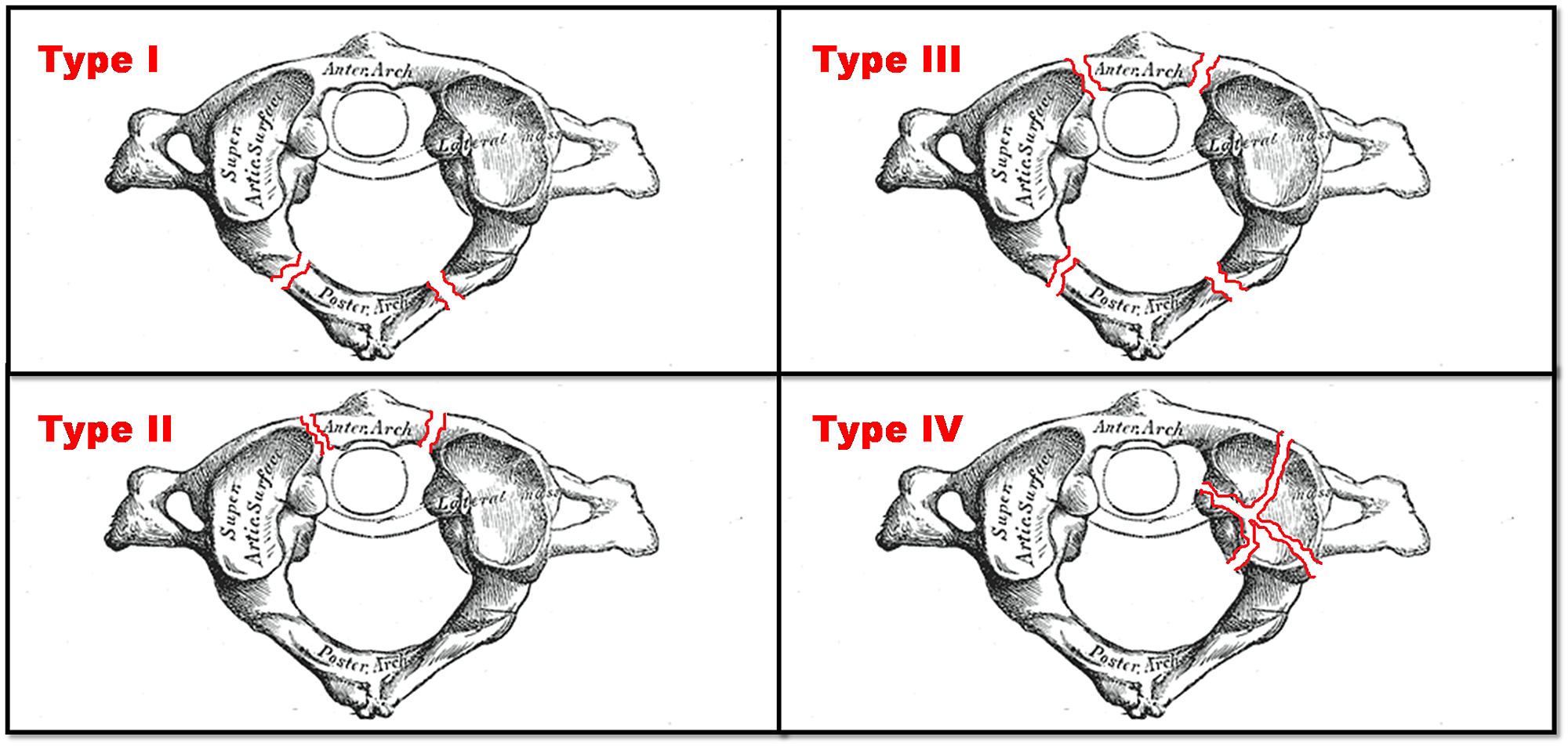 jefferson fracture types