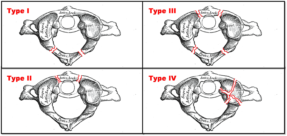 Cureus | Atlas Fracture with Concomitant Vertebral Artery Hypoplasia, a ...