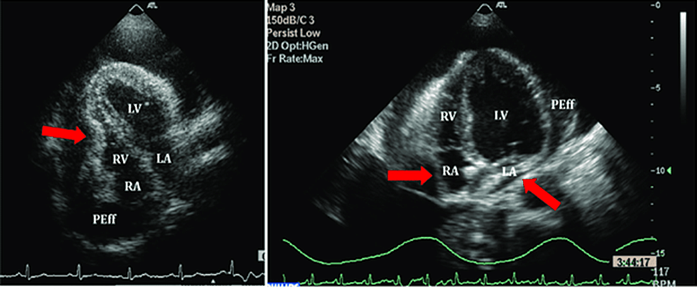 Cureus Iatrogenic Cardiac Tamponade Secondary To Central Venous Catheter Placement A