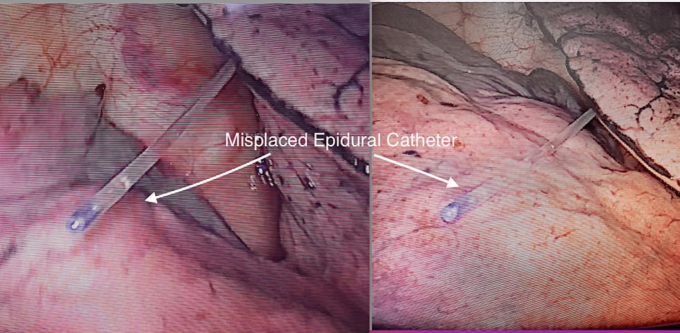 Misplaced-intrapleural-catheter-as-seen-during-video-assisted-thoracic-surgery-(VATS)