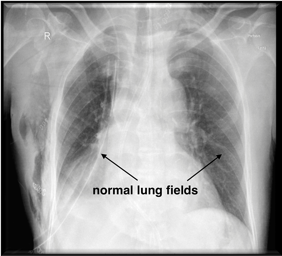 Normal-chest-x-ray-after-extubation