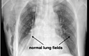 Inadvertent Placement Of Thoracic Epidural Catheter In Pleural Cavity 