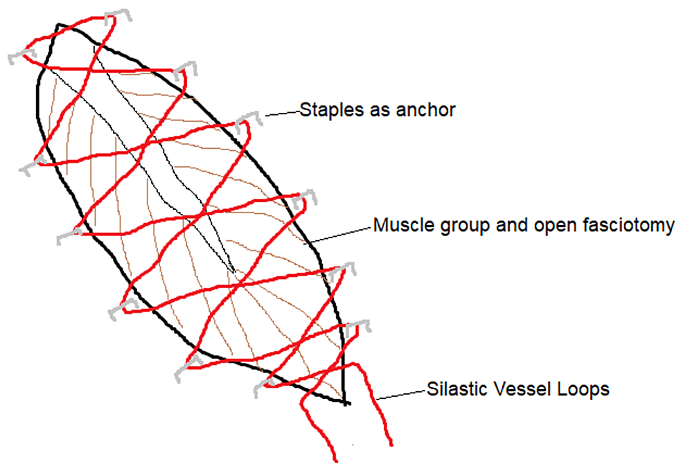 Suturing Dermatotraction Techniques in Closing Fasciotomy Wounds: A ...