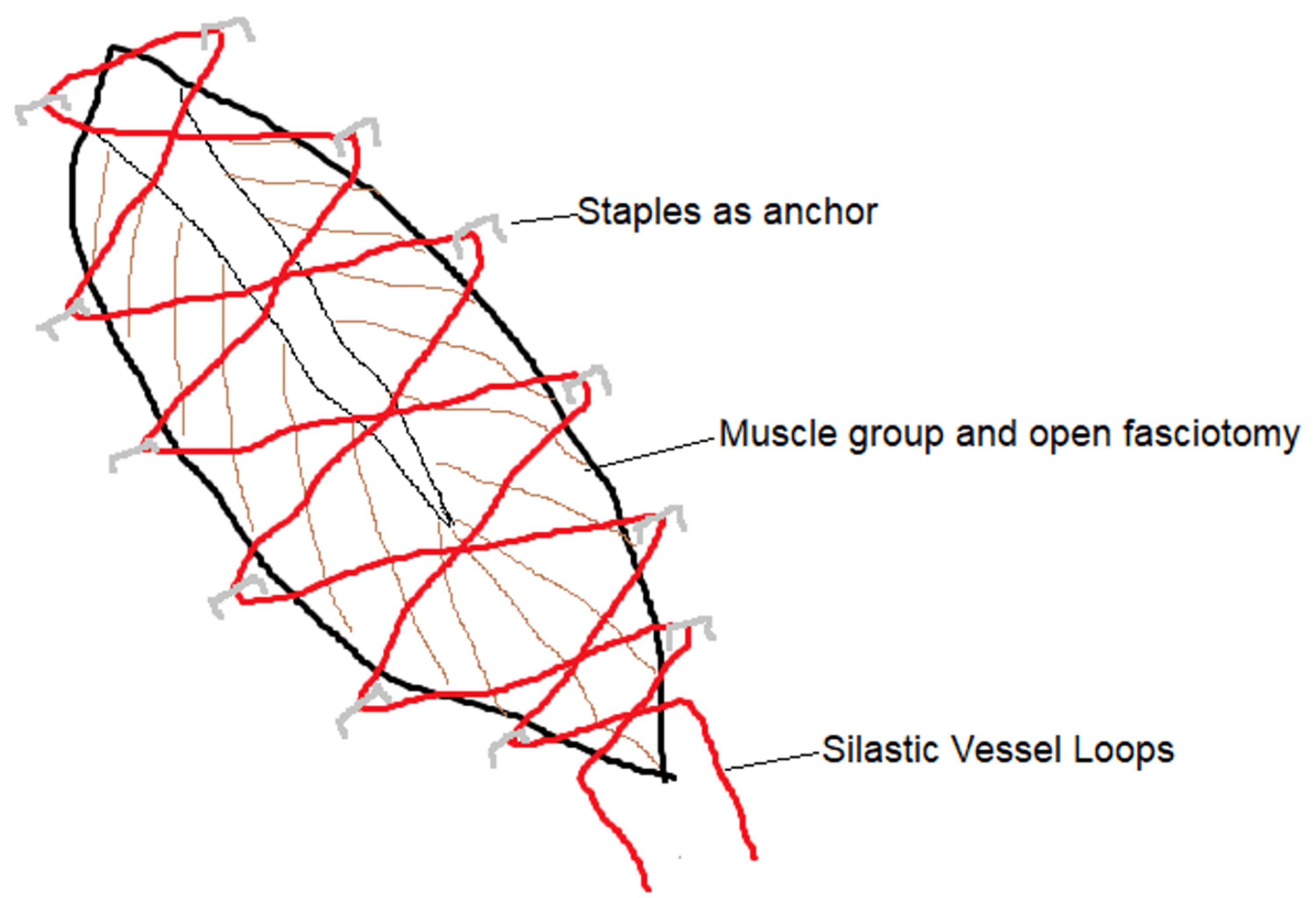 Cureus Suturing Dermatotraction Techniques in Closing Fasciotomy