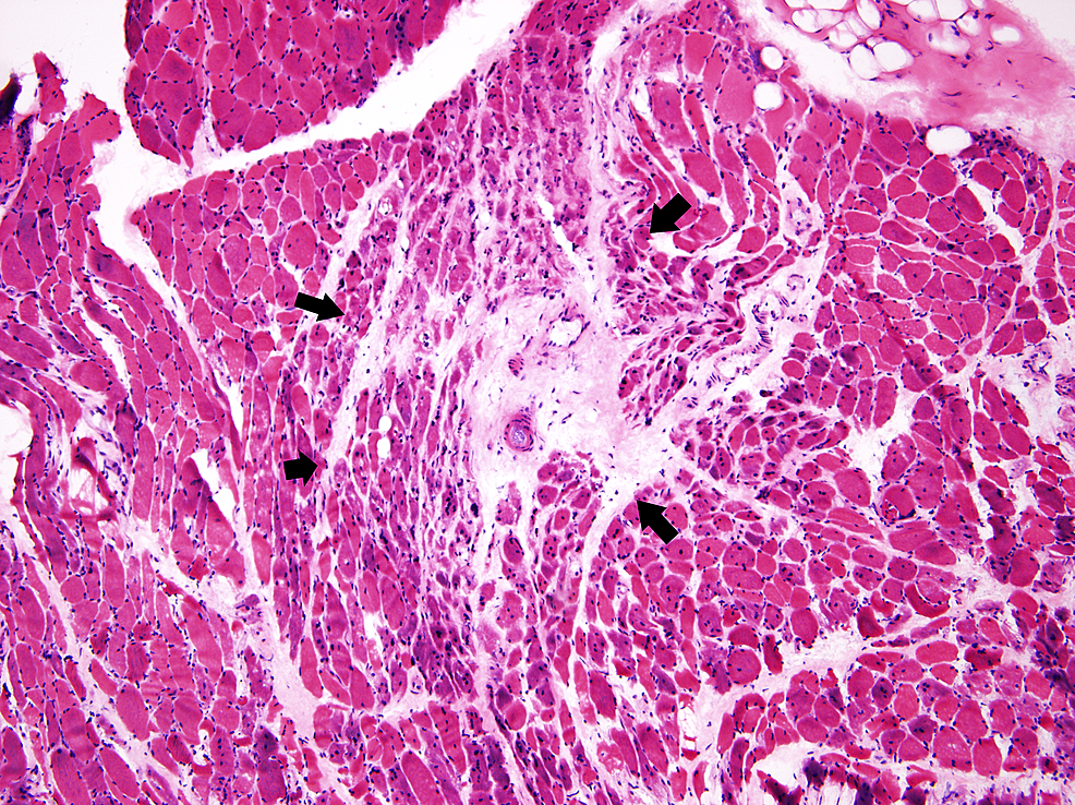 Cureus | Thin Patient, Fatty Liver