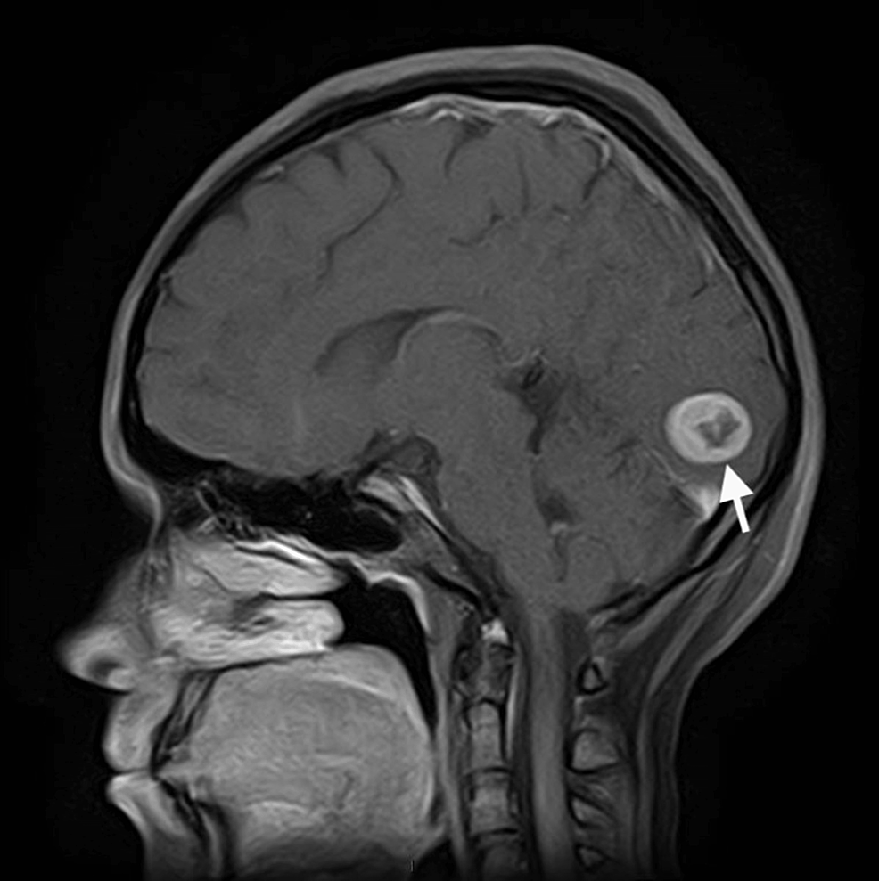 case-of-a-who-grade-ii-atypical-meningioma-in-a-16-year-old-female-cureus