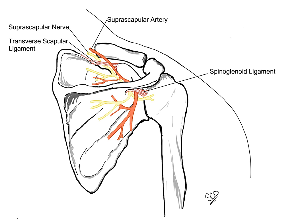 Cureus | Persistent Shoulder Pain Due to a Suprascapular Nerve Injury