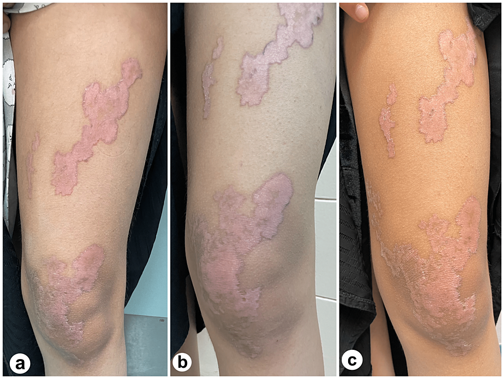 Share 105+ accutane and tattoos super hot tnbvietnam.edu.vn