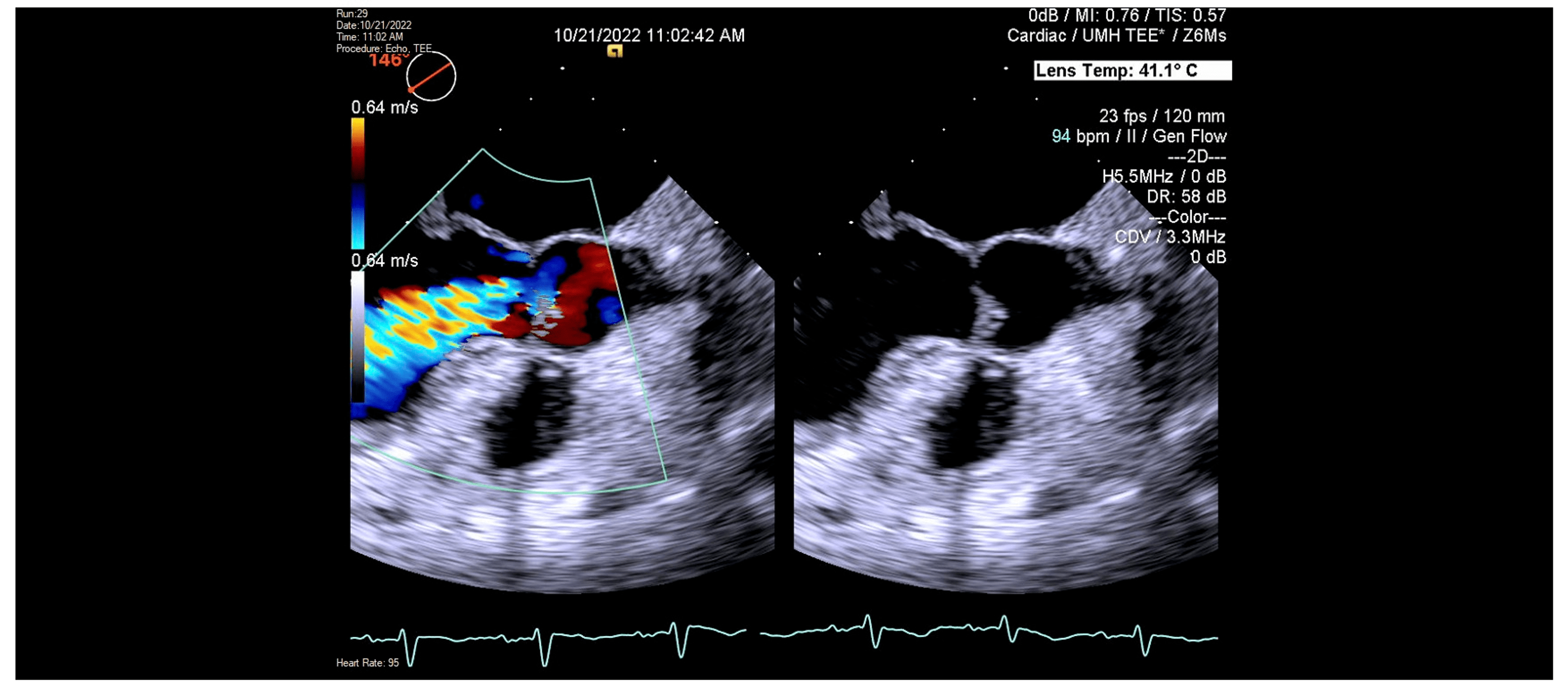 Cureus Incidental Perforation of Aortic Valve Leaflet Found on