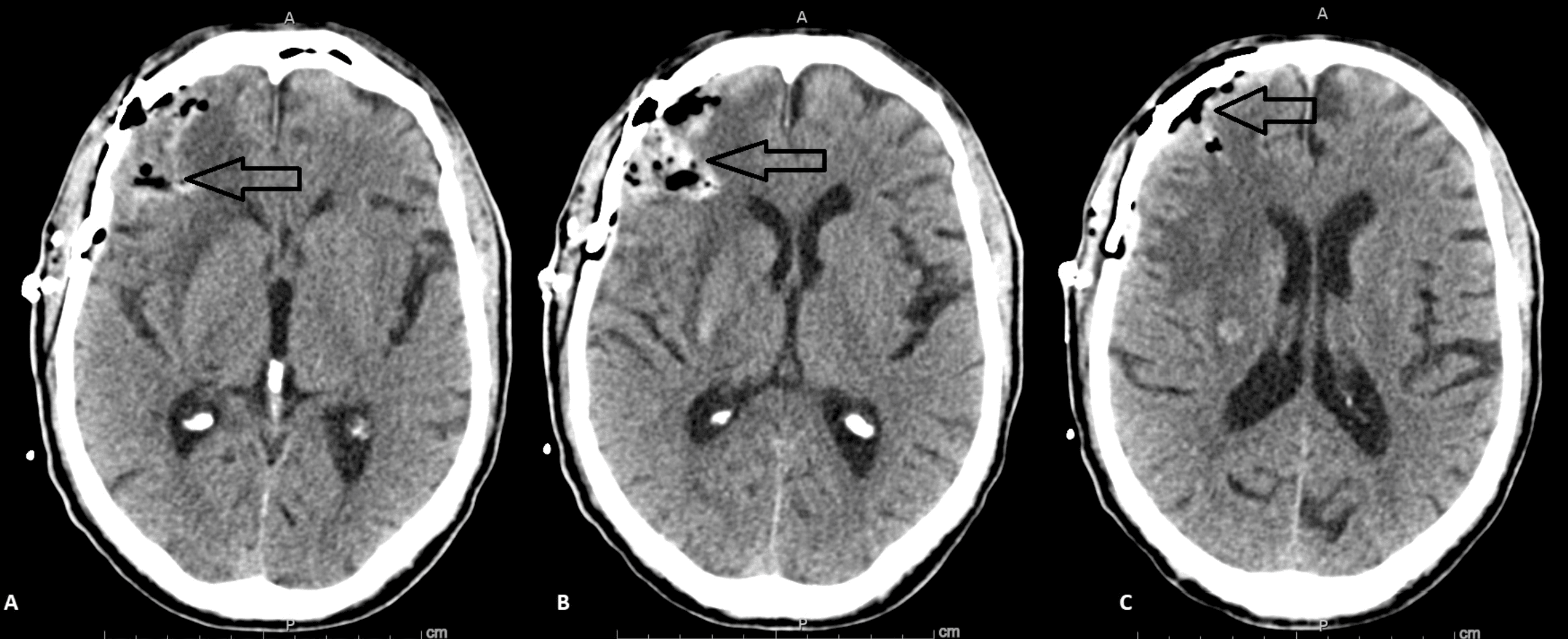 Cureus | Report of a Rare Case of Intracranial Extramedullary ...