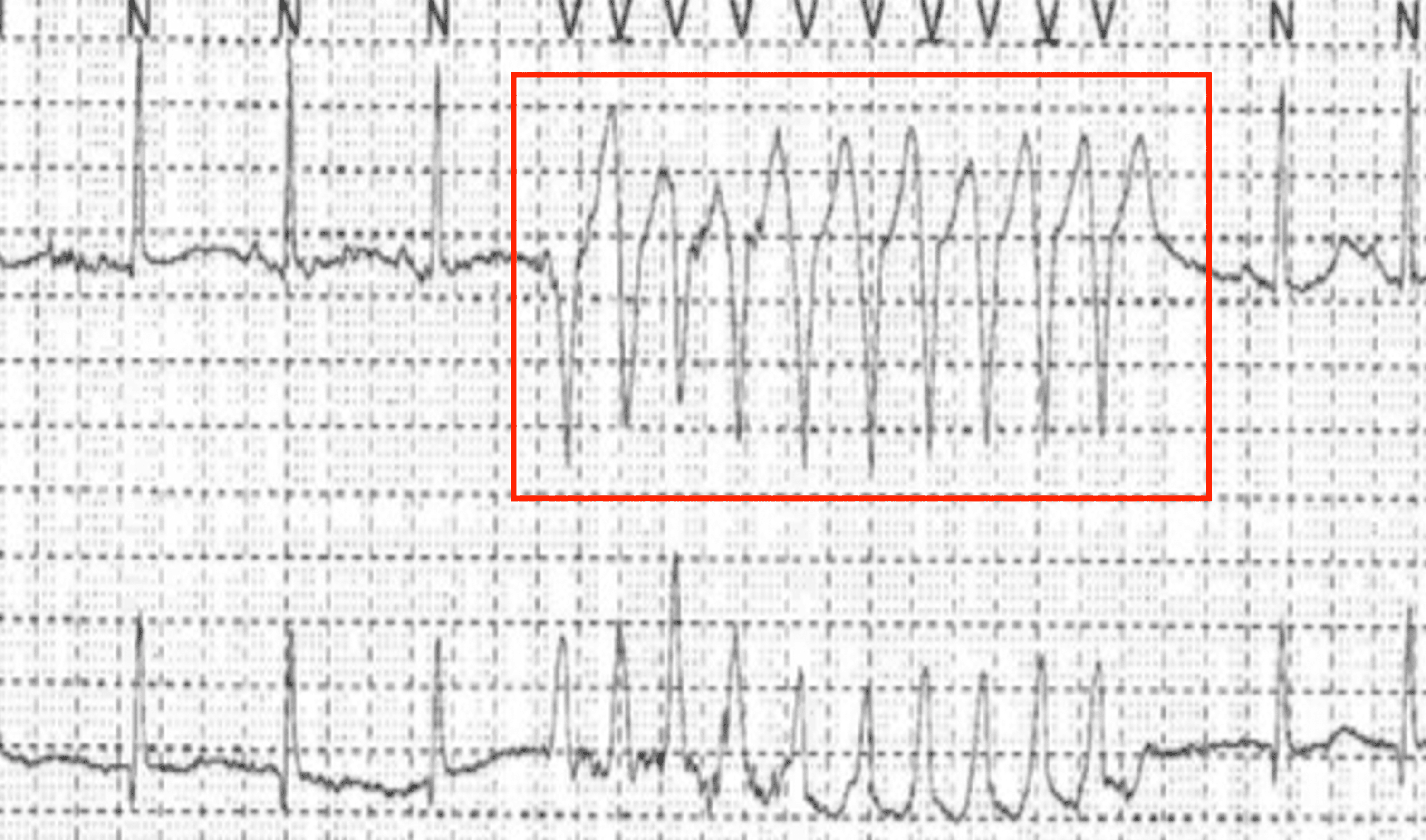 Cureus Nonsustained Ventricular Tachycardia as a Presentation of