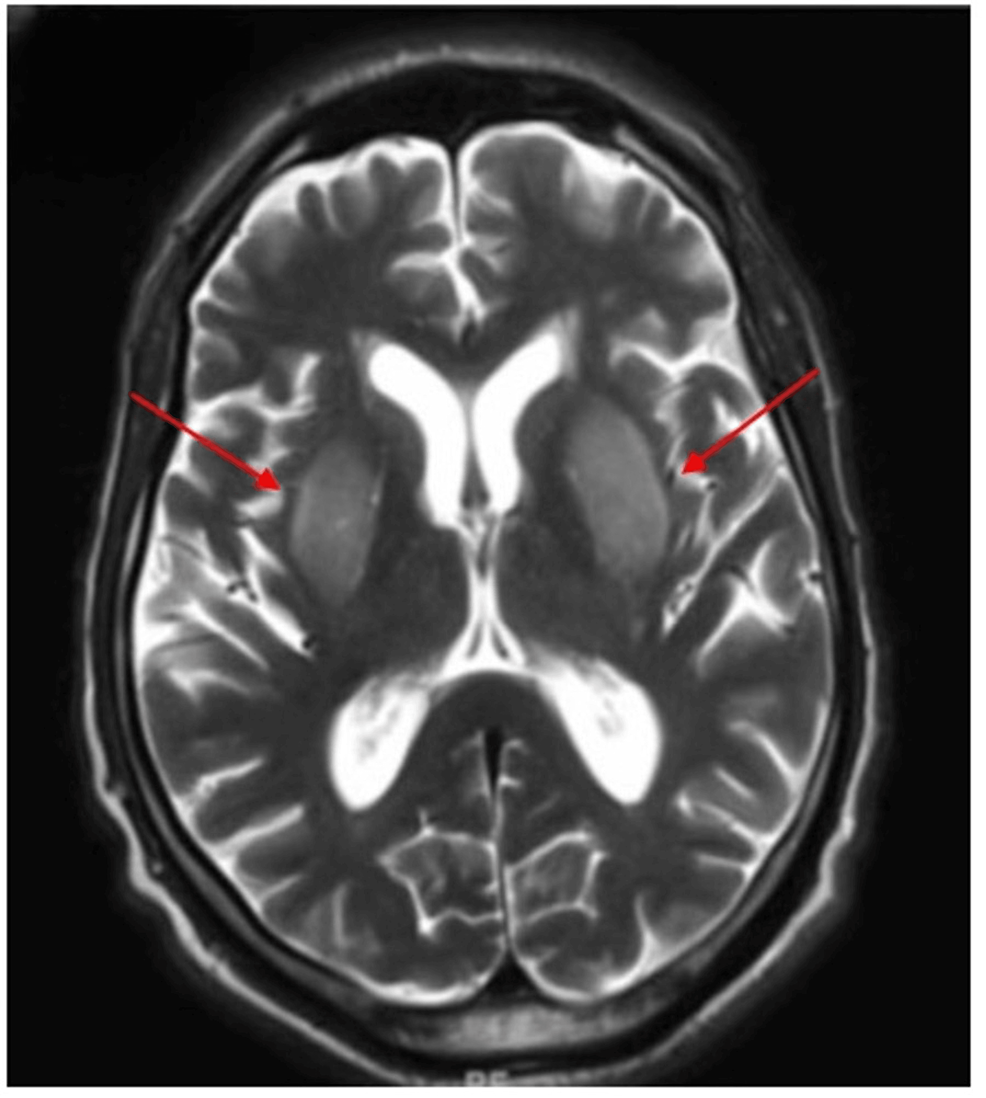 cureus-hypoglycemia-as-a-cause-of-reversible-recurrent-chorea-in-a