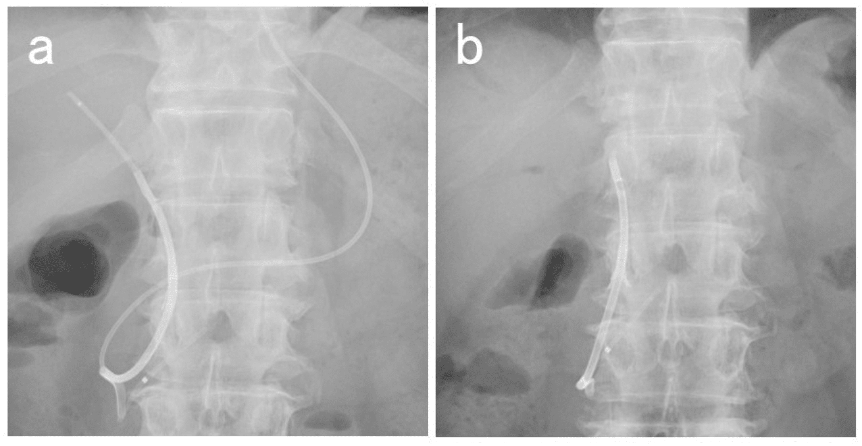 Cureus | Feasibility of Biliary Drainage Using a Novel Integrated ...