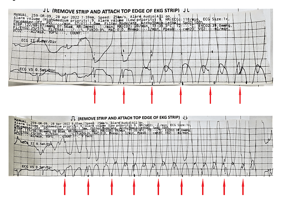 Cureus | Two Cases Of Intraoperative ECG Artifact Mimicking Ventricular ...