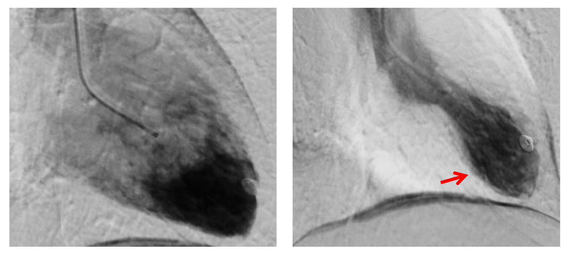 cureus-spontaneous-coronary-artery-dissection-in-a-postpartum-female