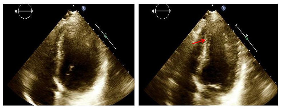 Cureus | Spontaneous Coronary Artery Dissection in a Postpartum Female: Case Report and ...