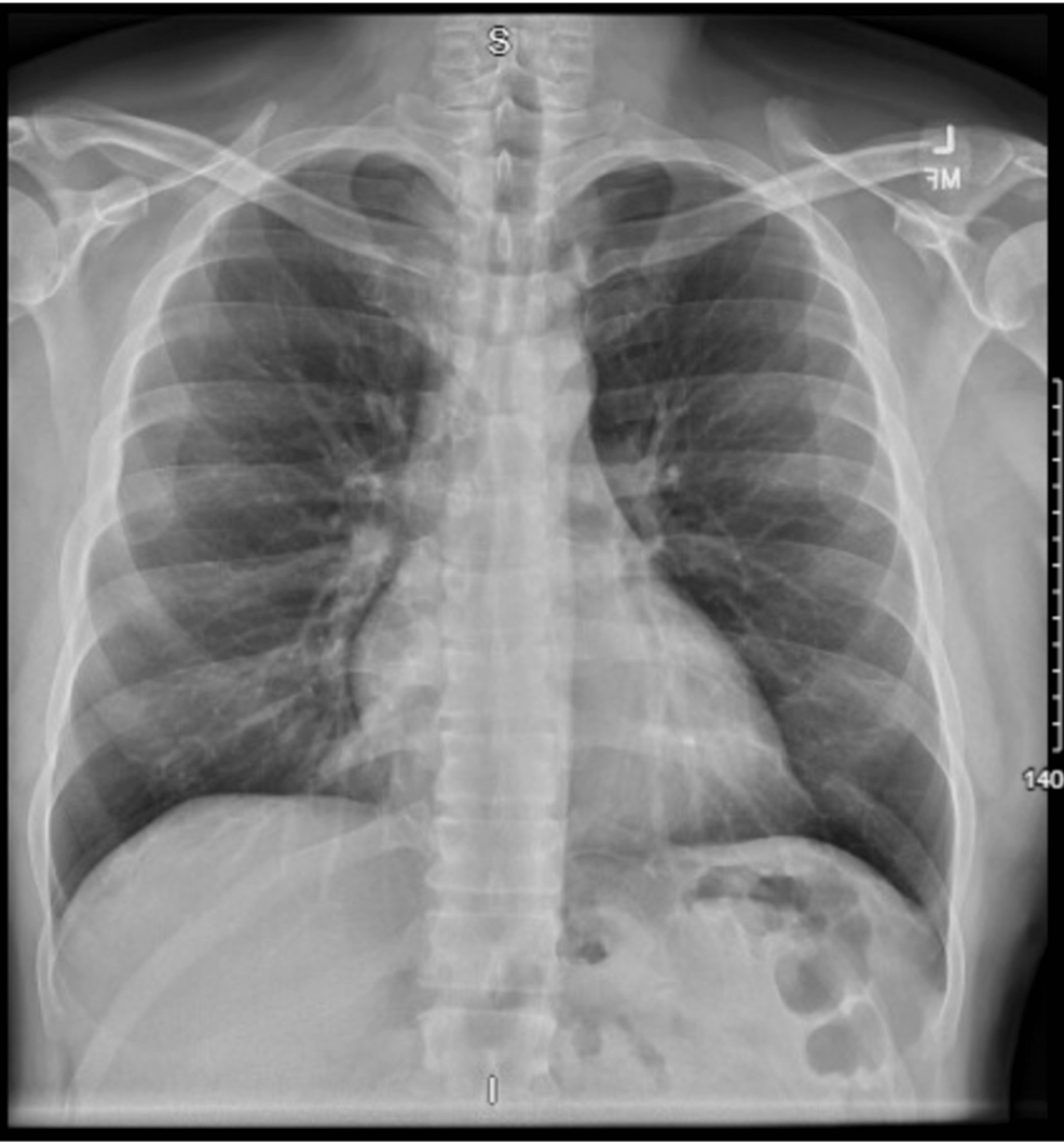 Cureus | Sternoclavicular Septic Arthritis: A Case Report