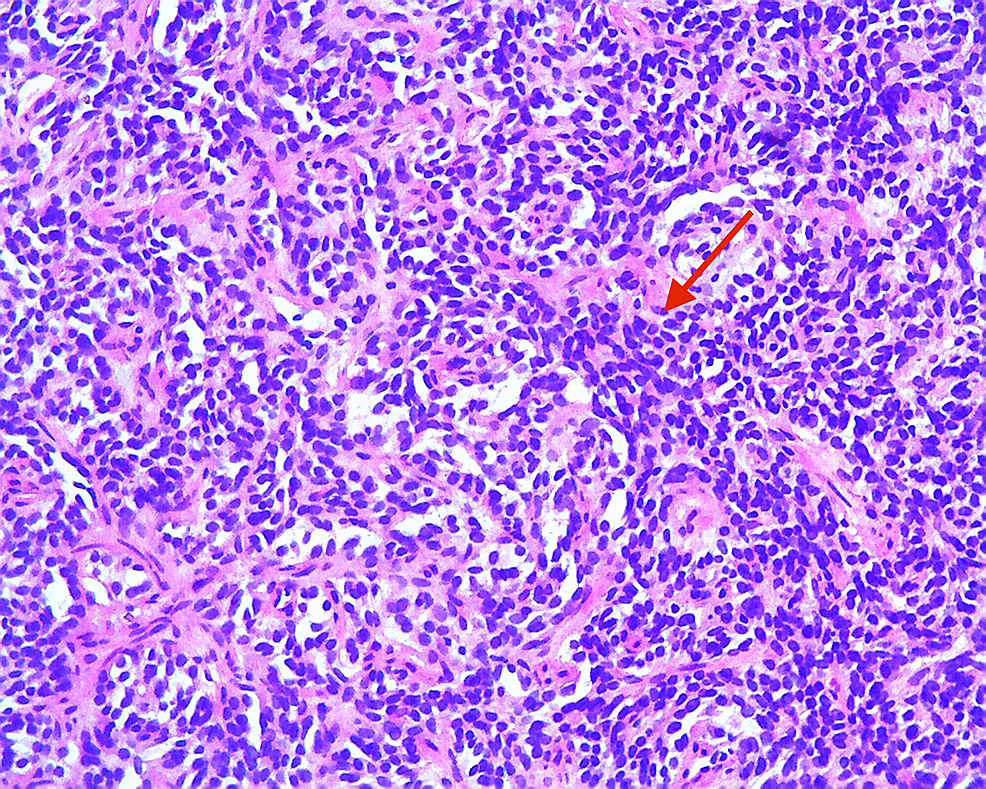 Cureus Type 1 Gastric Neuroendocrine Tumor Found on Endoscopic