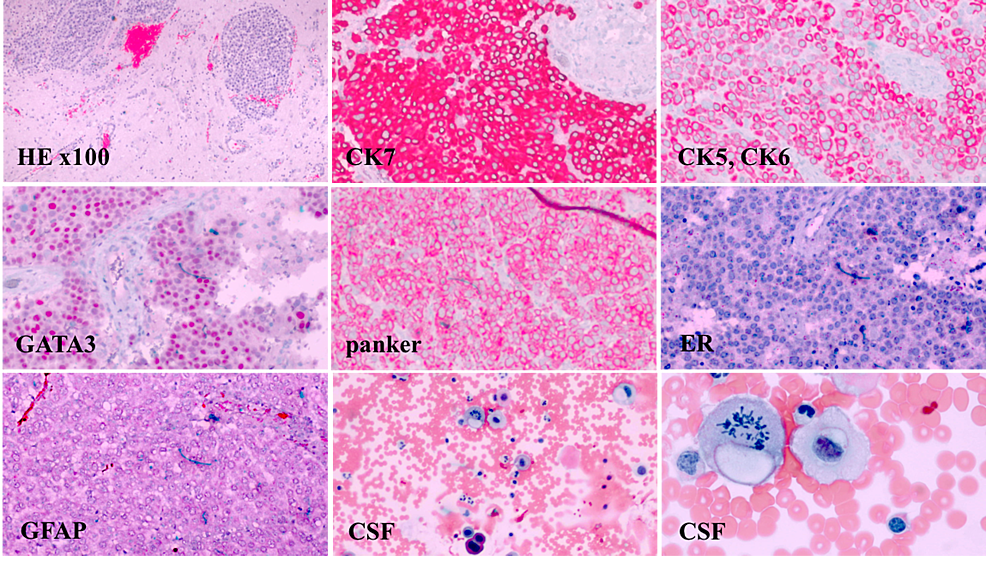 The-pathology-specimen-demonstrates-poorly-differentiated-metastatic-carcinoma-of-the-breast.-