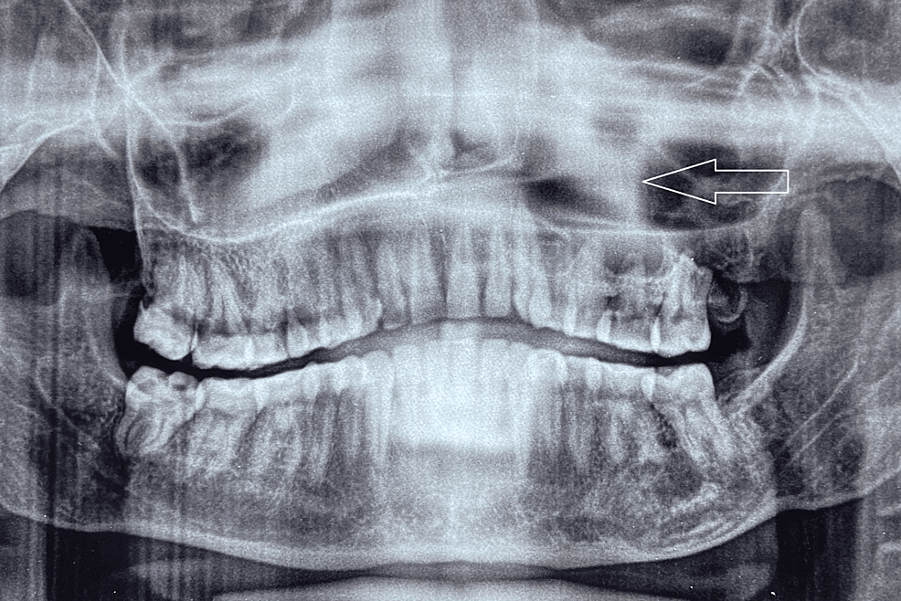 Cureus An Unusual Case of Maxillary Sinus Odontogenic Keratocyst An