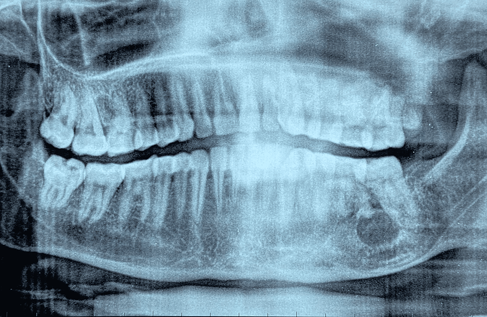 Cureus An Unusual Case of Maxillary Sinus Odontogenic Keratocyst An
