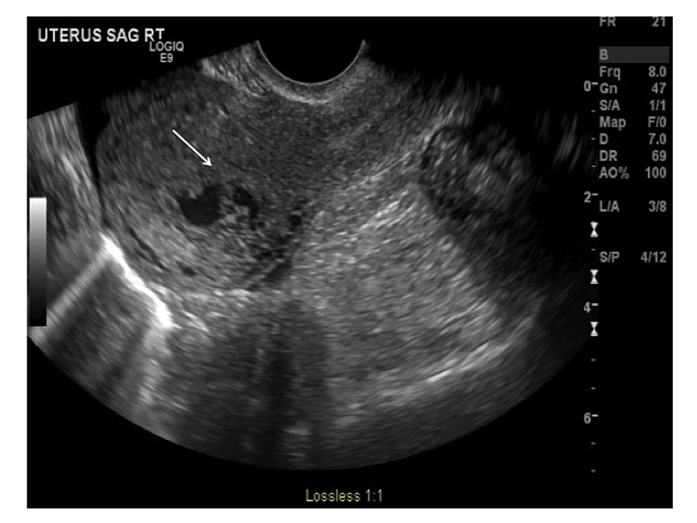 cureus-acquired-uterine-arteriovenous-malformation-following