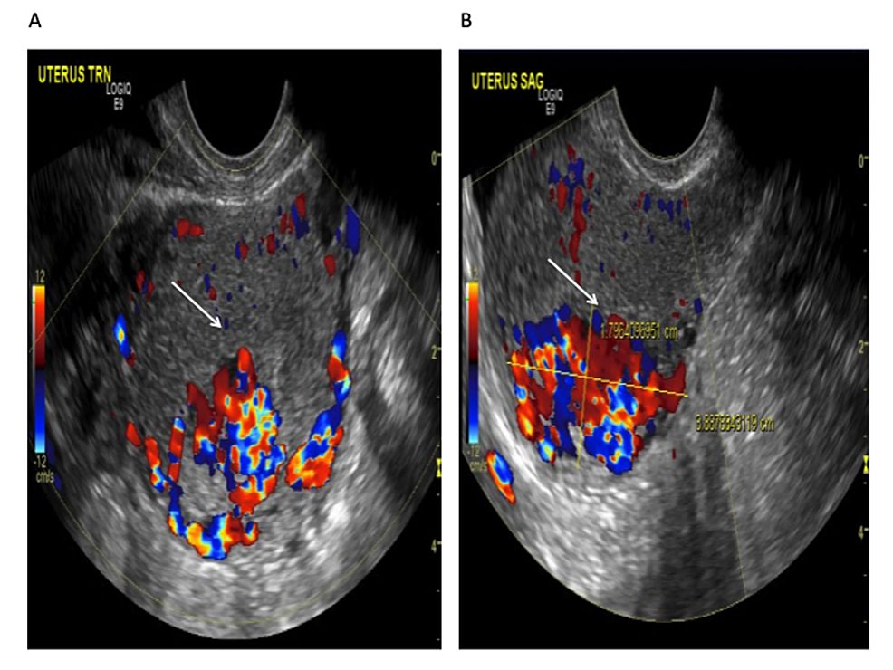 Transvaginal-ultrasound-of-the-uterus-with-Doppler-revealing-a-hypervascular-lesion:-(A)-transverse-view-(B)-sagittal-view