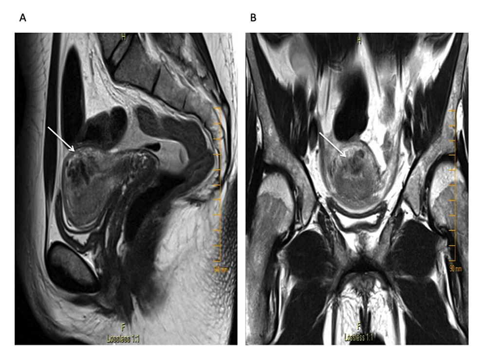 T2-weighted-pelvic-magnetic-resonance-imaging-(MRI)-revealing-a-hypointense-T2-lesion-within-the-posterosuperior-wall-of-the-myometrium:-(A)-sagittal-view-(B)-axial-view