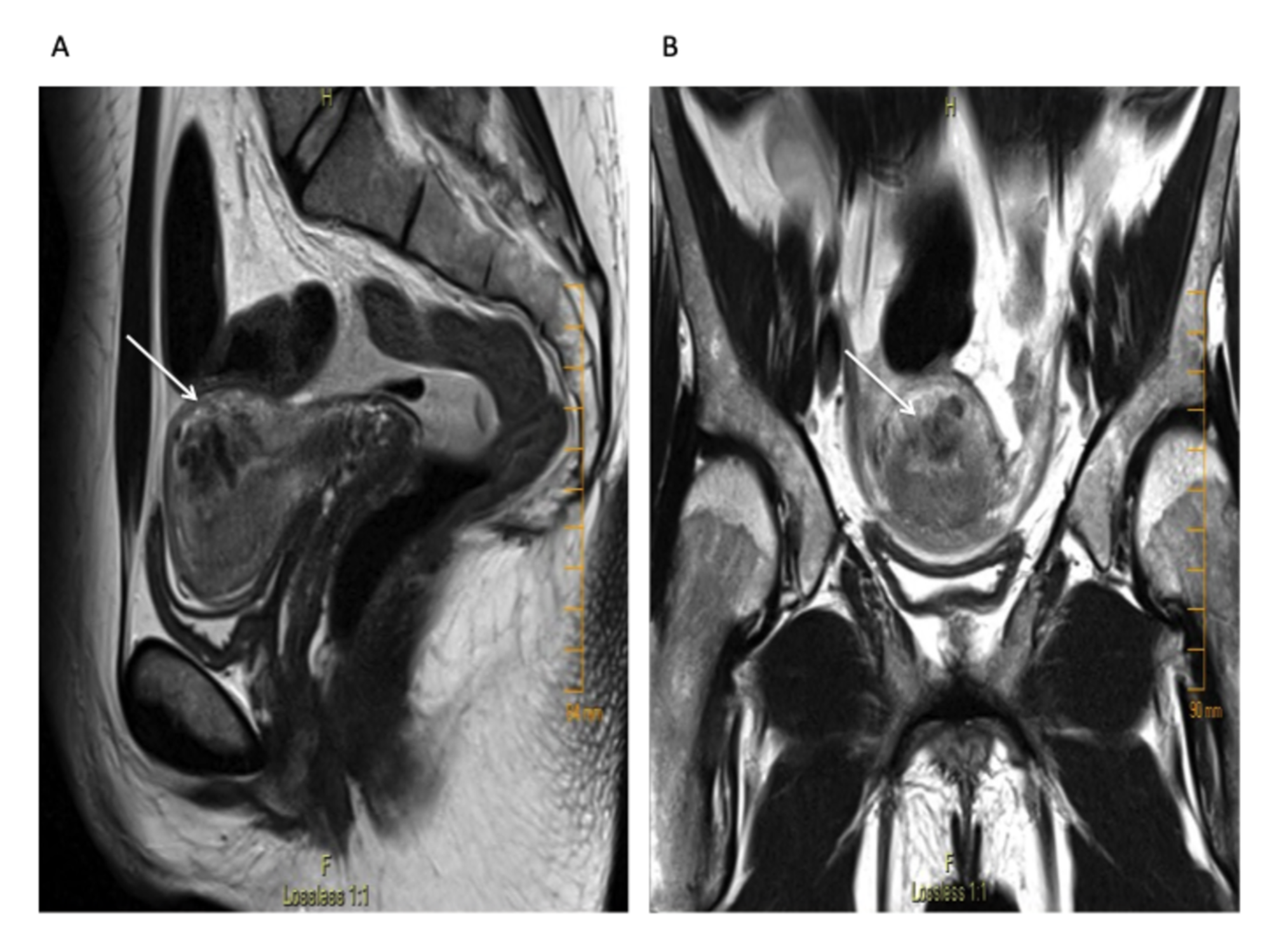 Uterus Anatomy Mri