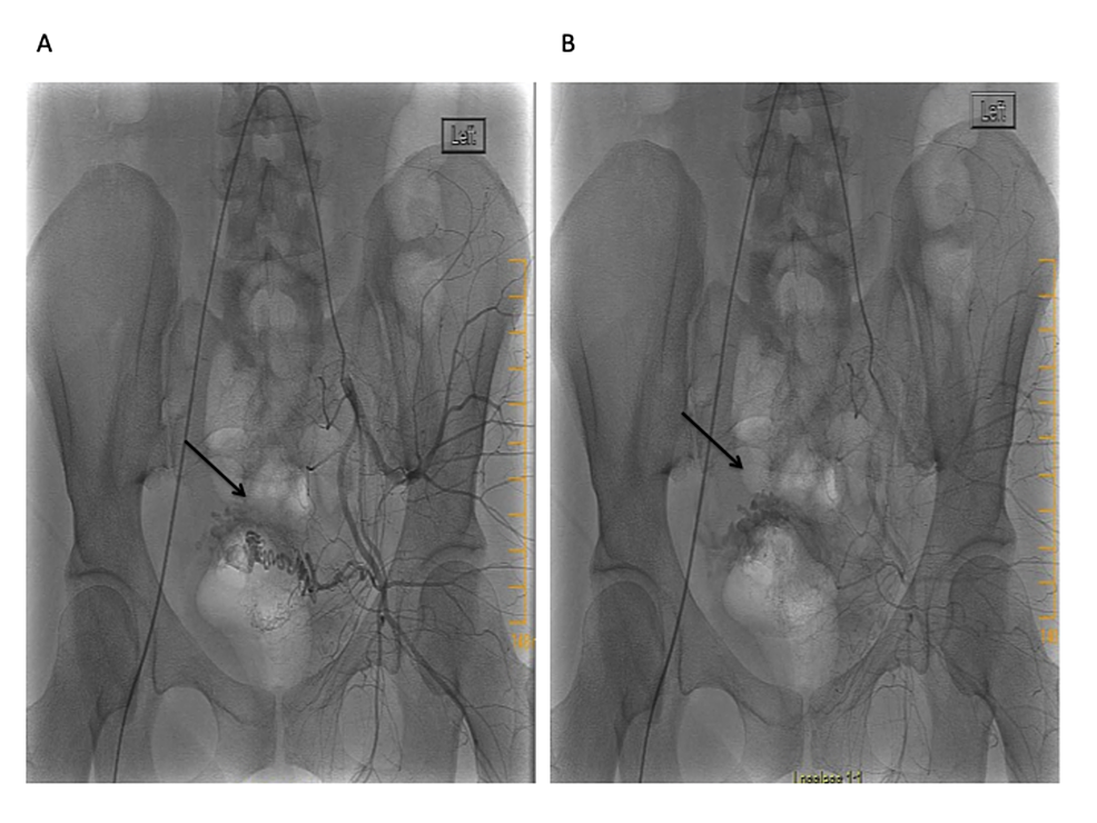 Left-internal-iliac-artery-angiogram-revealing-a-hypervascular-lesion-within-the-uterine-artery-distribution-with-early-venous-filling-during-the-late-arterial-phase:-(A)-early-arterial-phase-(B)-late-arterial-phase