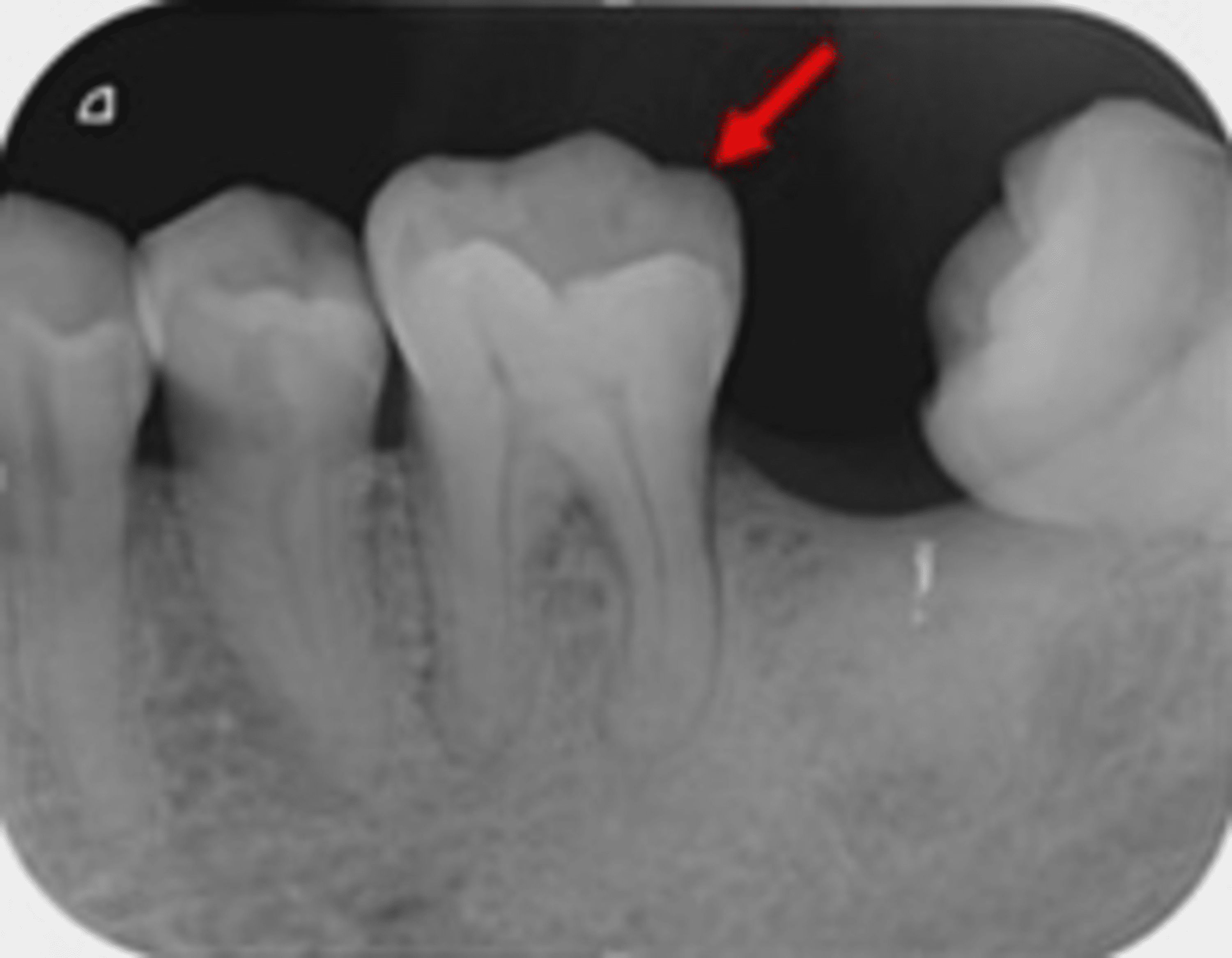 Milled Crown on Post Crack Tooth Syndrome as the Denture Abutment Tooth