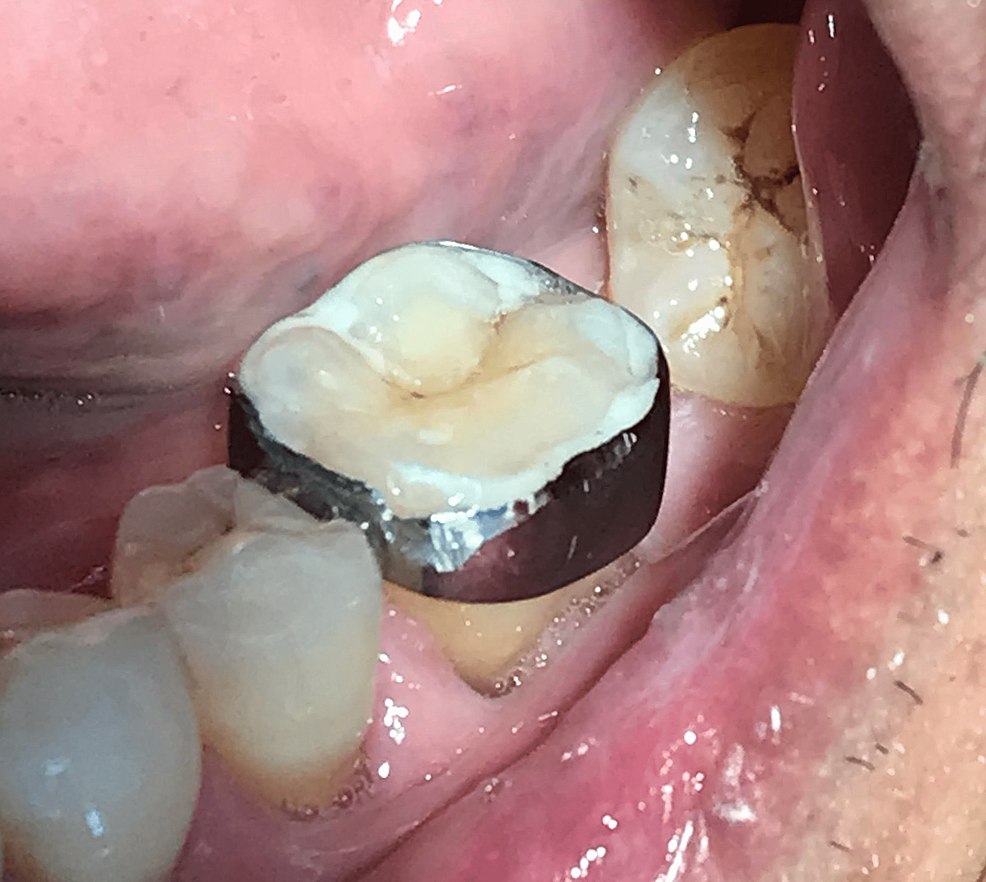Cureus Milled Crown on Post Crack Tooth Syndrome as the Denture