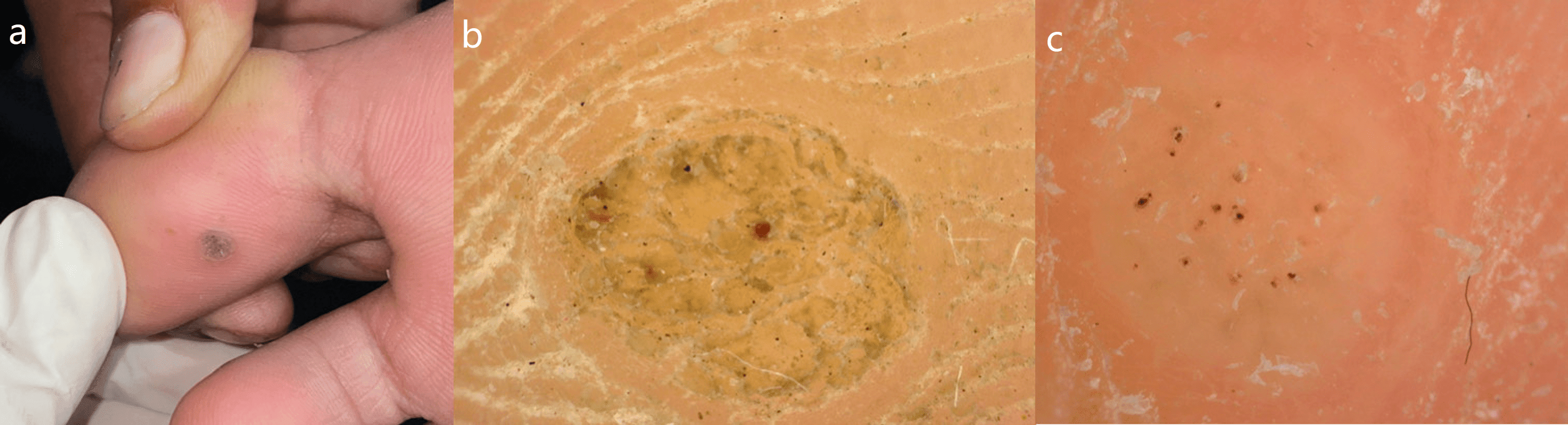 Cureus Dermoscopic Findings in Clinically Diagnosed Cases of Plantar