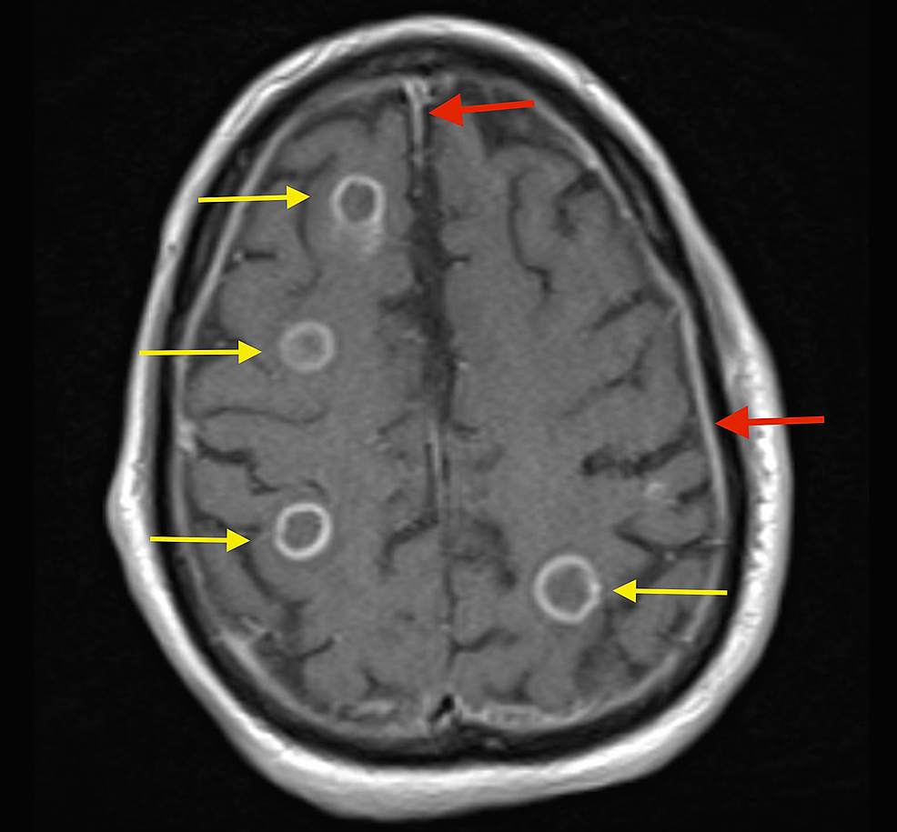 Cureus Disseminated Central Nervous System Histoplasmosis A Case Report