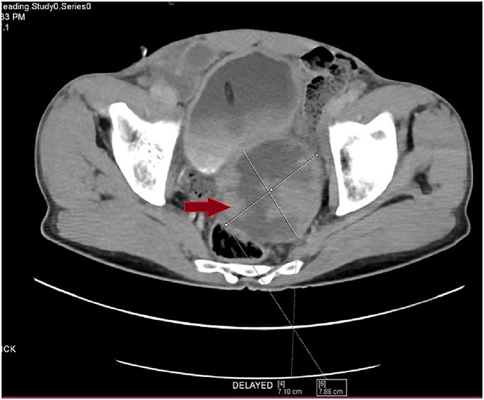 Cureus Rare Variant Of Carcinoma Prostate Masquerading As Benign Prostatic Hyperplasia 7497