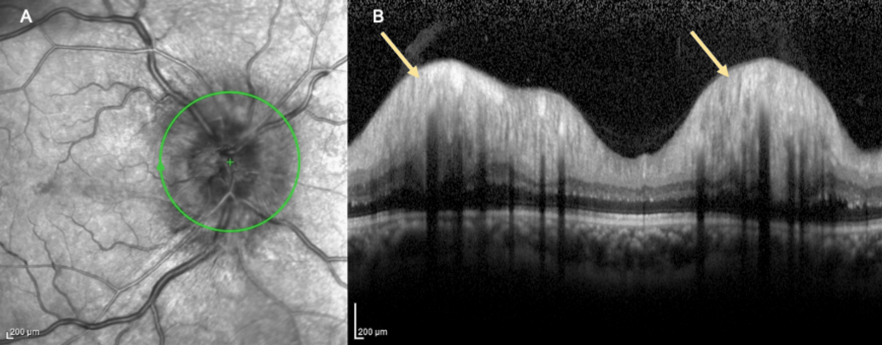 Myelin Oligodendrocyte Glycoprotein Optic Neuritis Presenting With ...