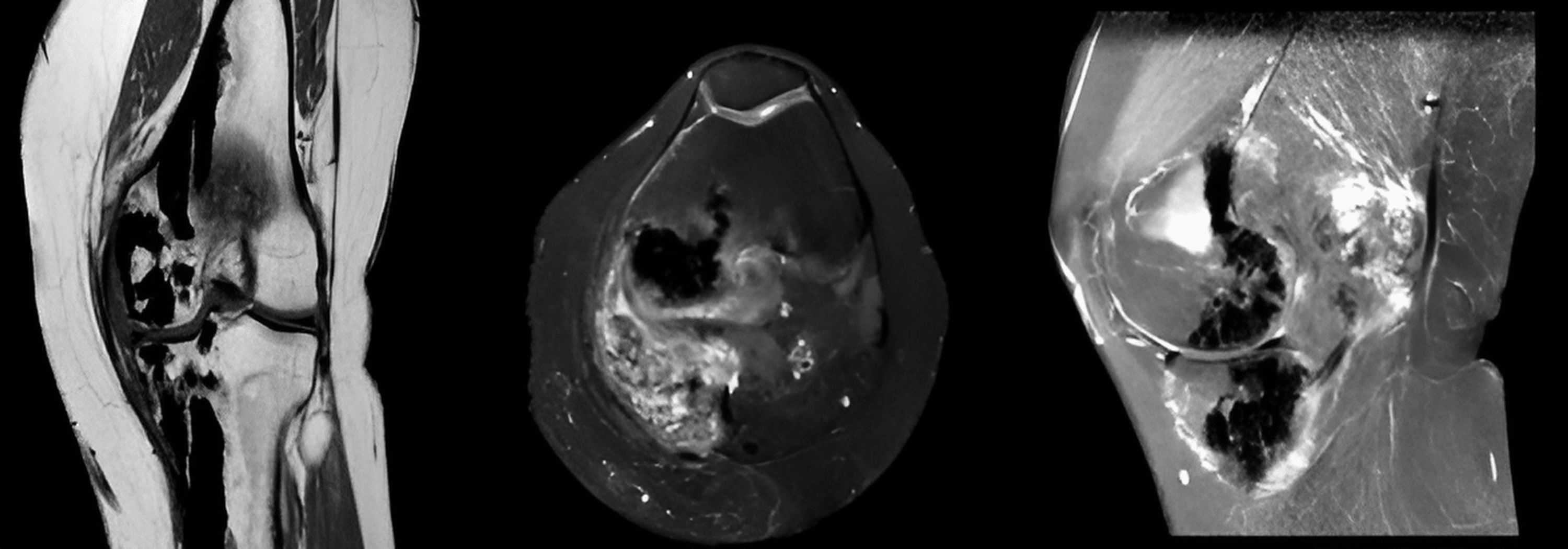Cureus BuschkeOllendorff Syndrome A Rare Cause of Unilateral Genu