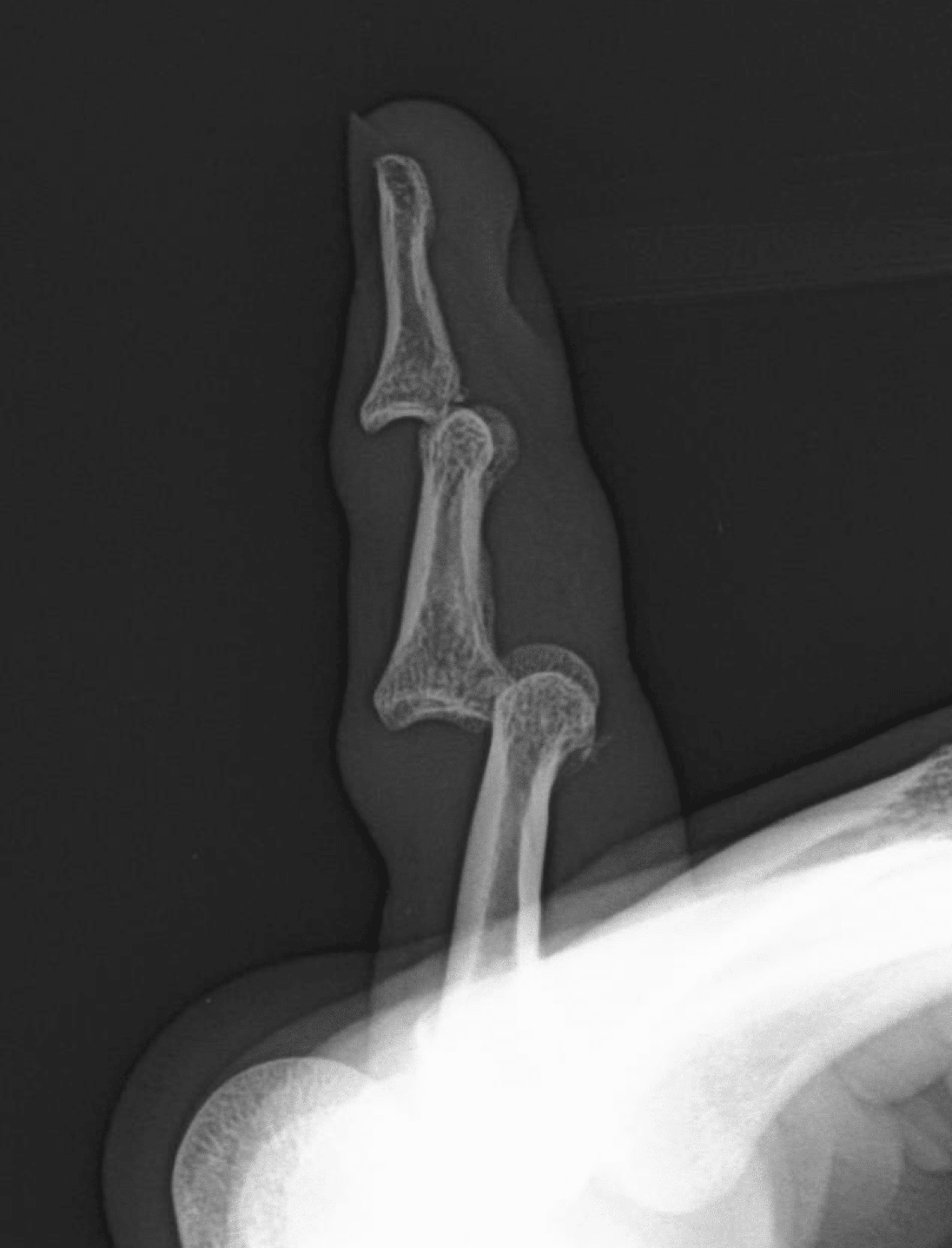 Cureus Double Dislocation of the Interphalangeal Joints of the Little