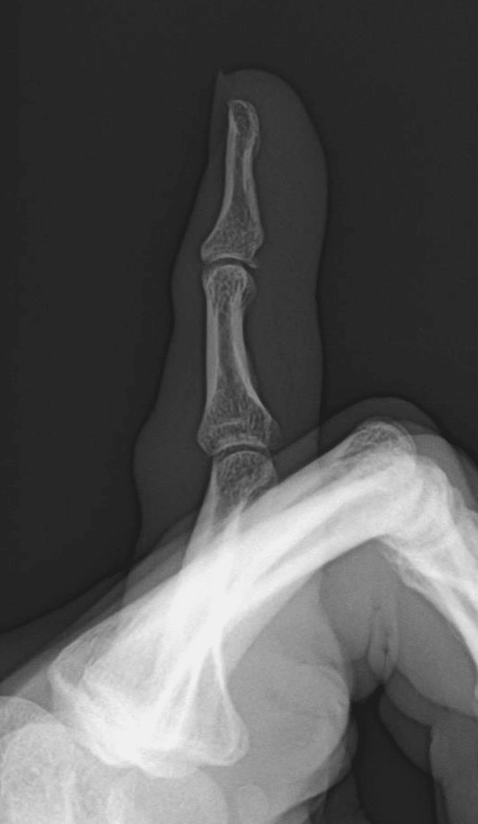 Cureus Double Dislocation of the Interphalangeal Joints of the Little