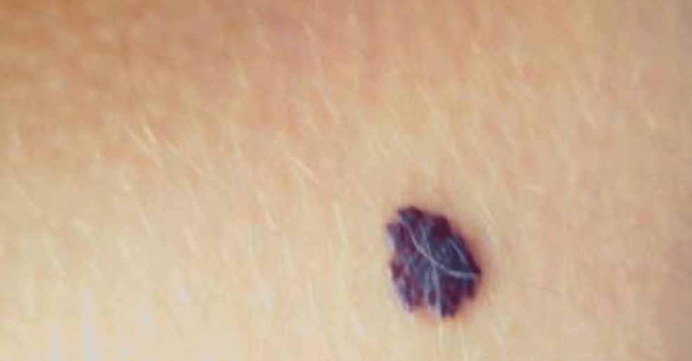 Cureus  Solitary Angiokeratoma in a Young Man: A Rare Case Report