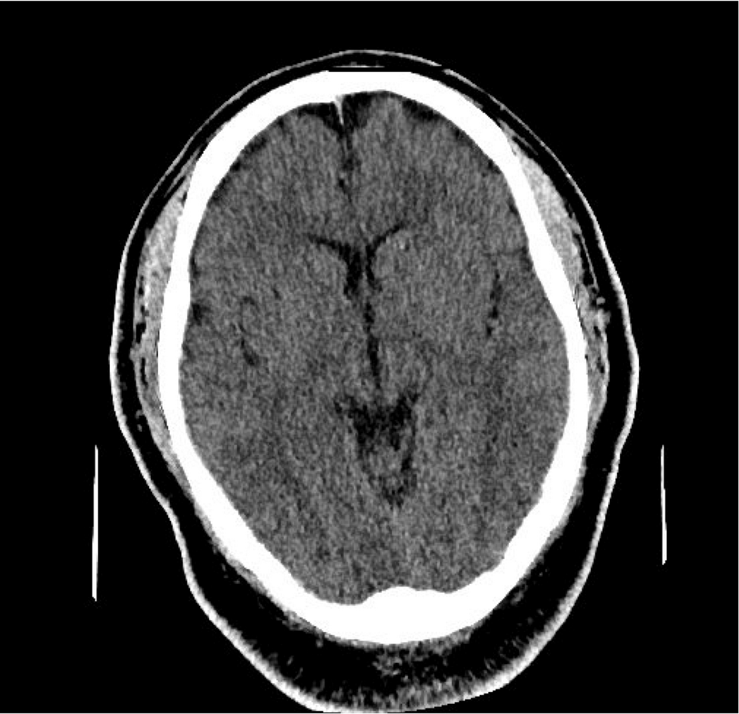 Cureus | An Unusual Case of Escherichia Coli Meningitis in an ...