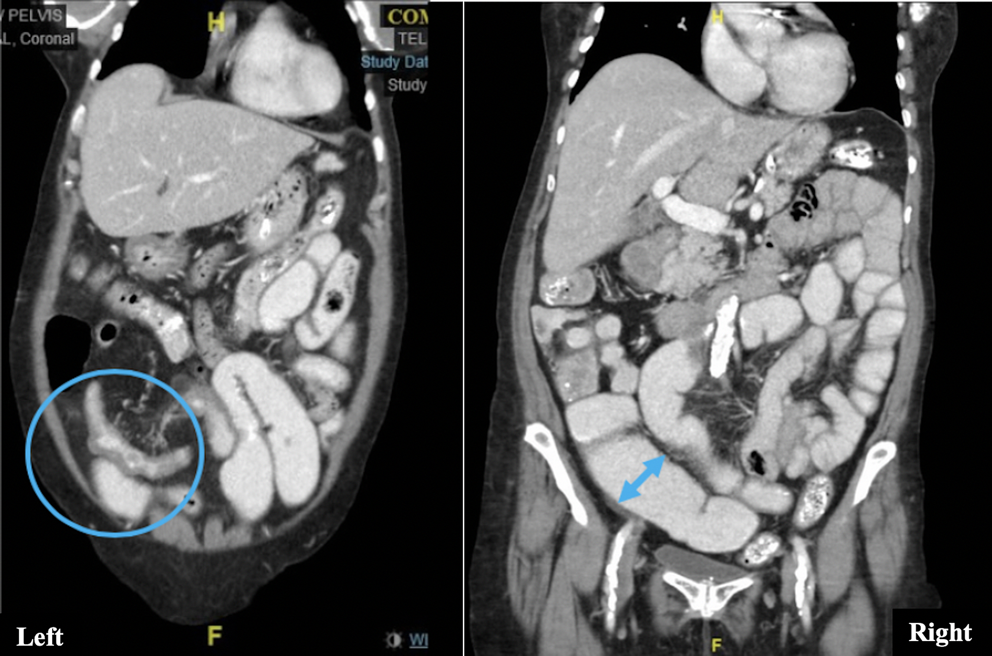 Cureus Intestinal Tuberculosis and Crohn’s Disease is Always a