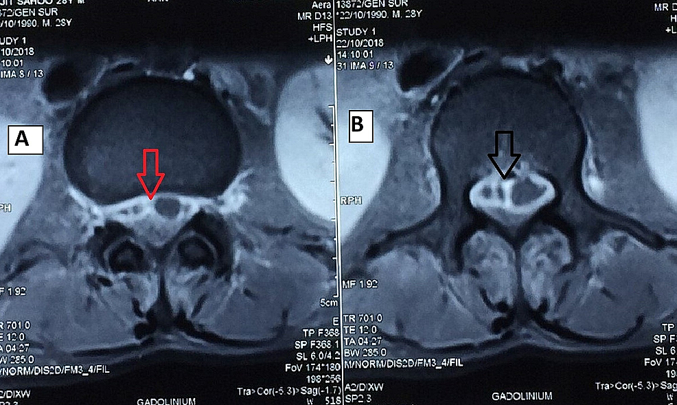 Cureus | Spinal Epidural Abscess in Melioidosis: A Rare Case Report ...