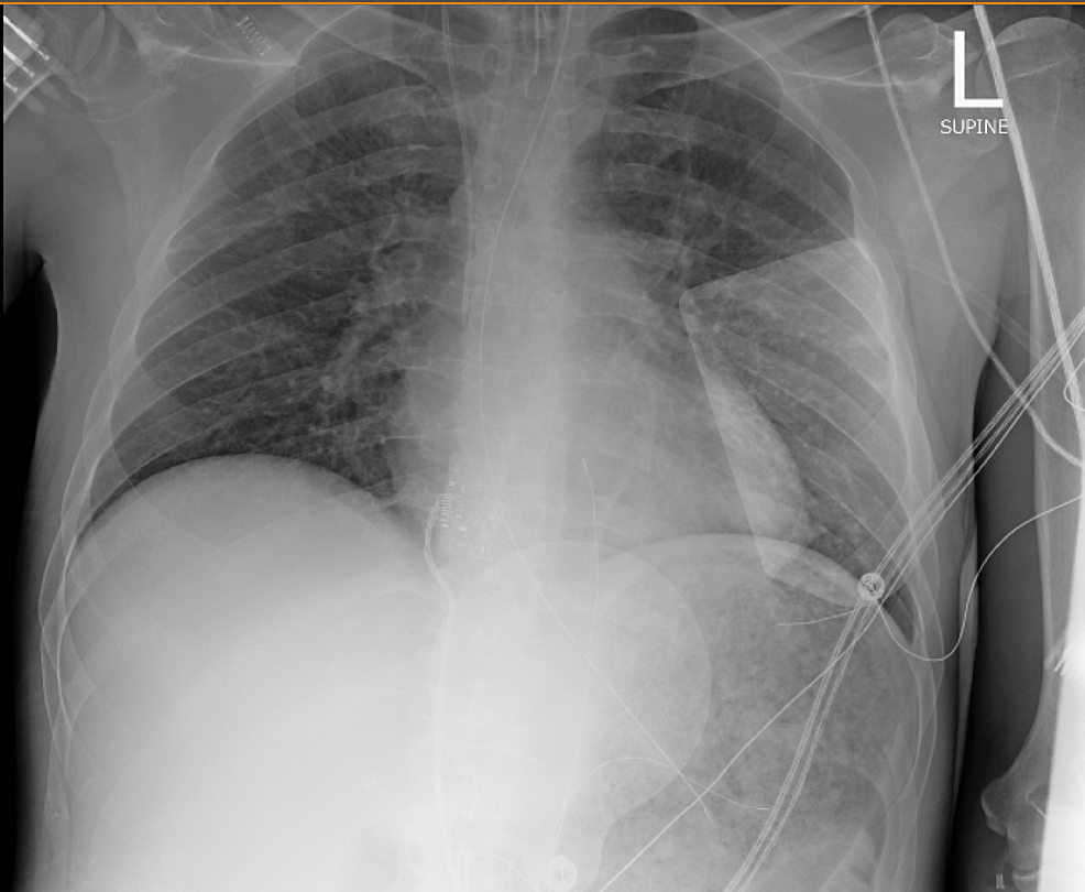 Cureus | A Rare Case of Leuconostoc pseudomesenteroides Bacteremia and ...