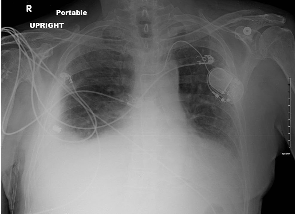 cureus-asbestos-exposure-and-development-of-pulmonary-pleomorphic-carcinoma-in-a-non-smoker-a