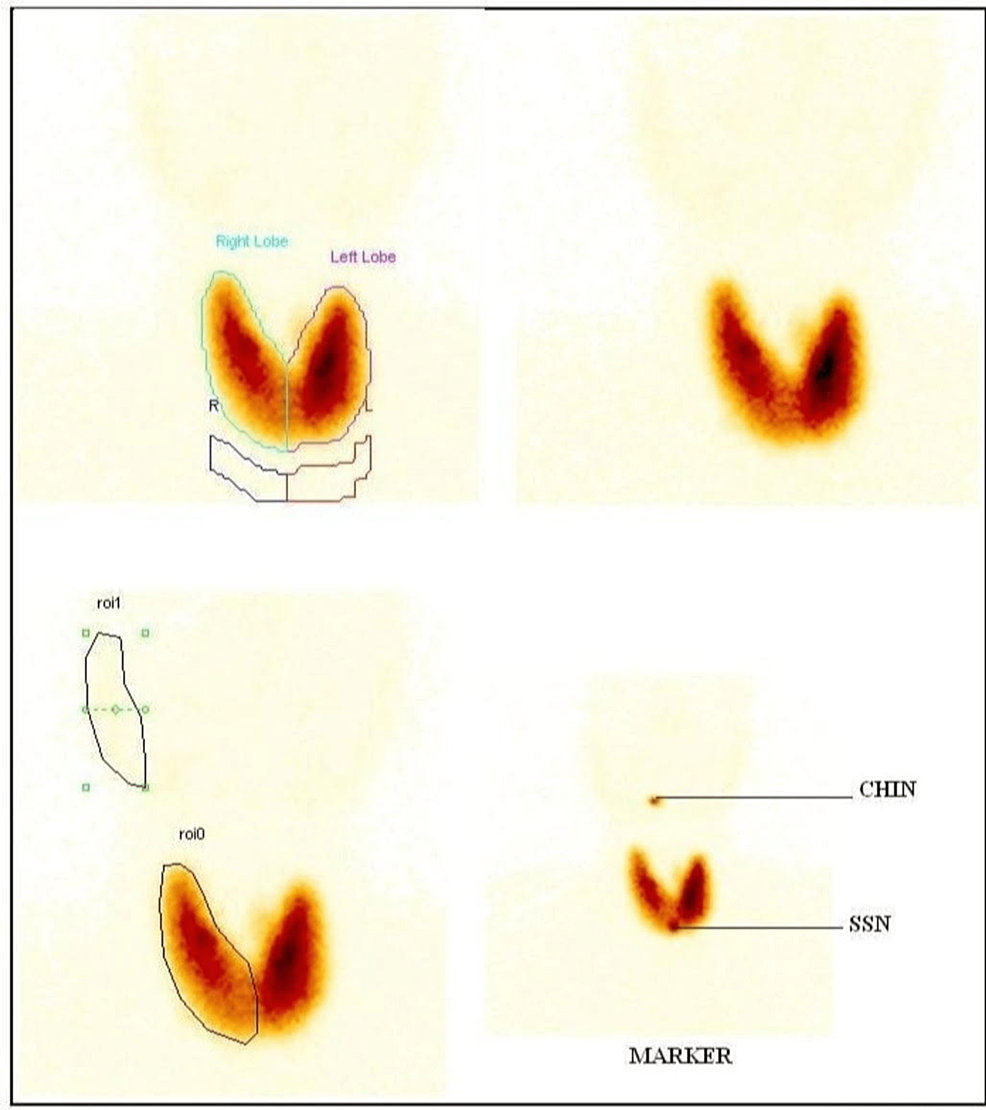 An Intriguing Case of in an Elderly Male as the Initial