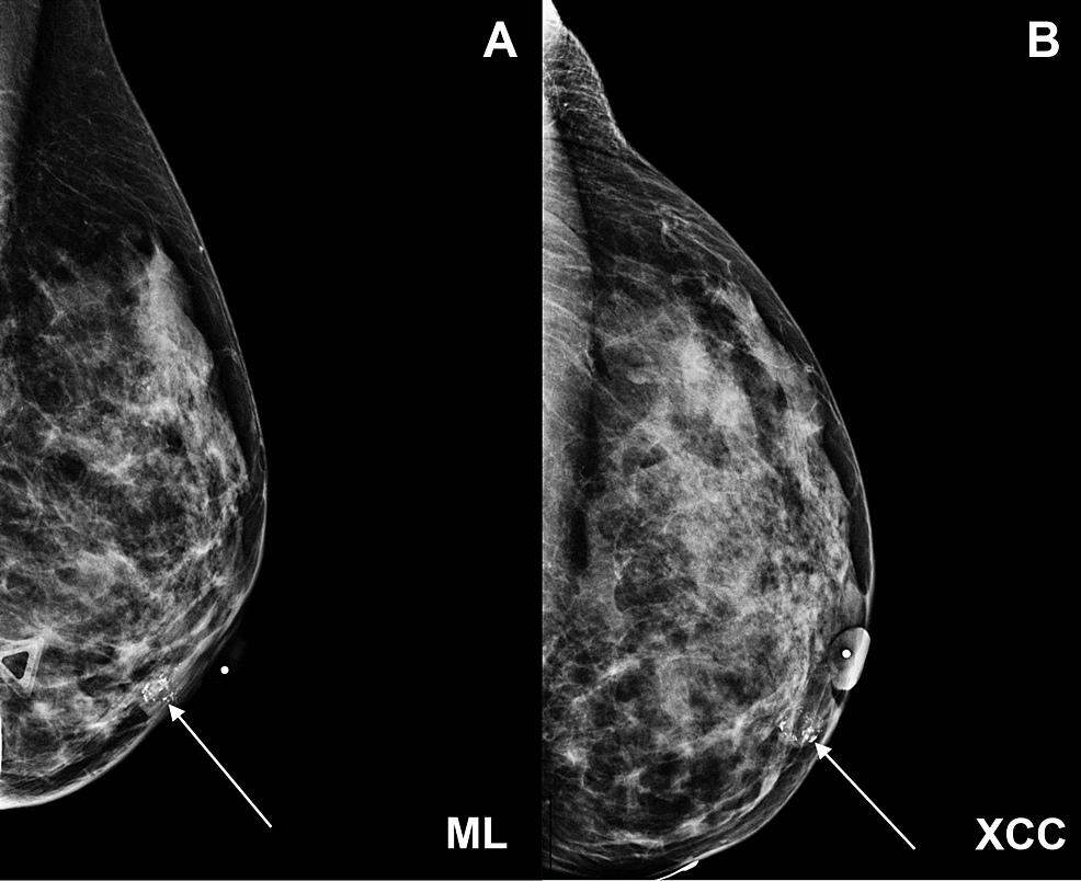 A mammogram of female breast, revealing micro-calcifications (white