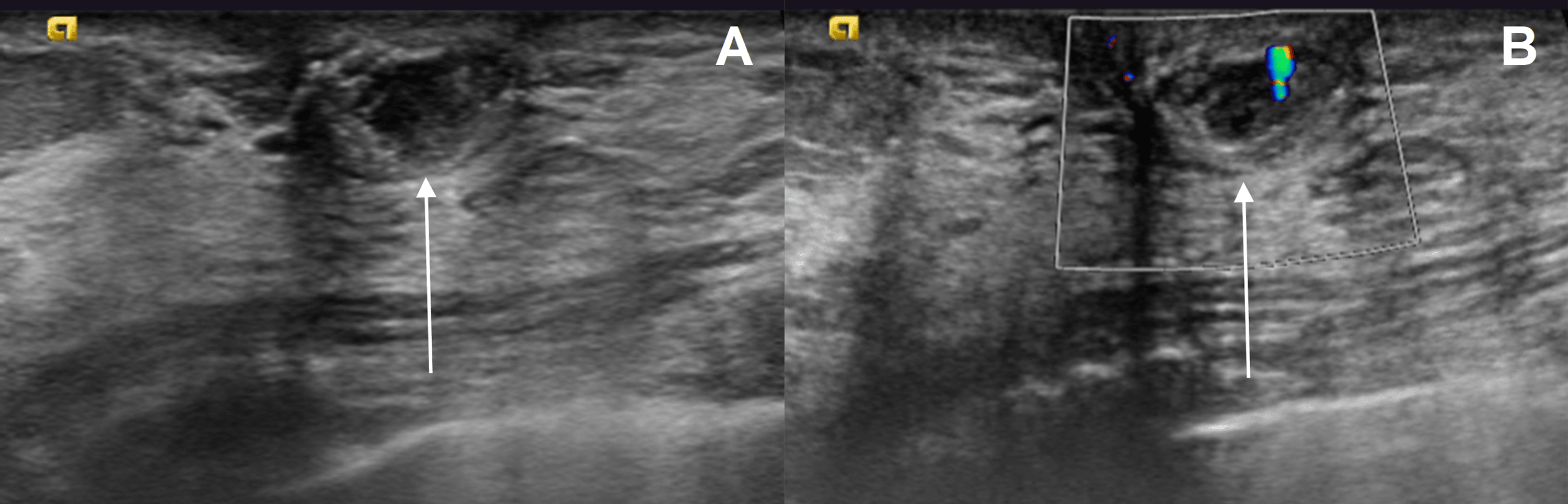 MucoceleLike Lesion of the Breast Cureus