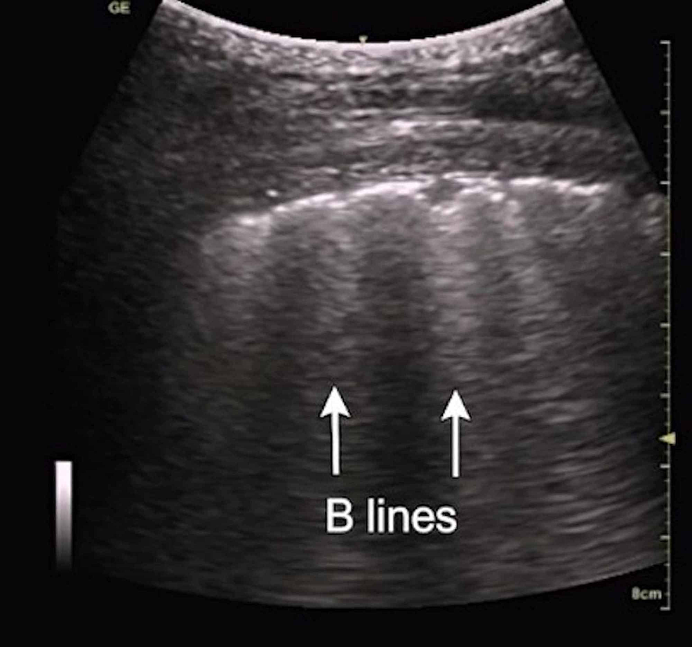 Cureus | Application Of Lung Ultrasound In Critical Care Setting: A Review